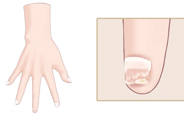 灰指甲是怎么治疗的 怎么治疗灰指甲